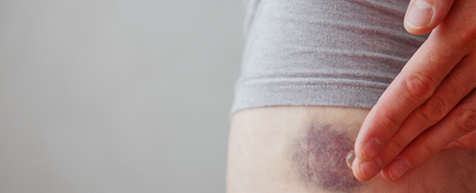 Imagem de pessoa passando pomada em um ferimento para tematizar Pomada para cicatrização: vale a pena vender?